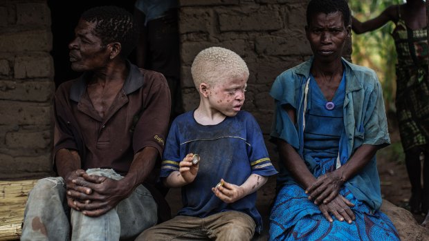 Kroegcollege: Albinisme in Afrika